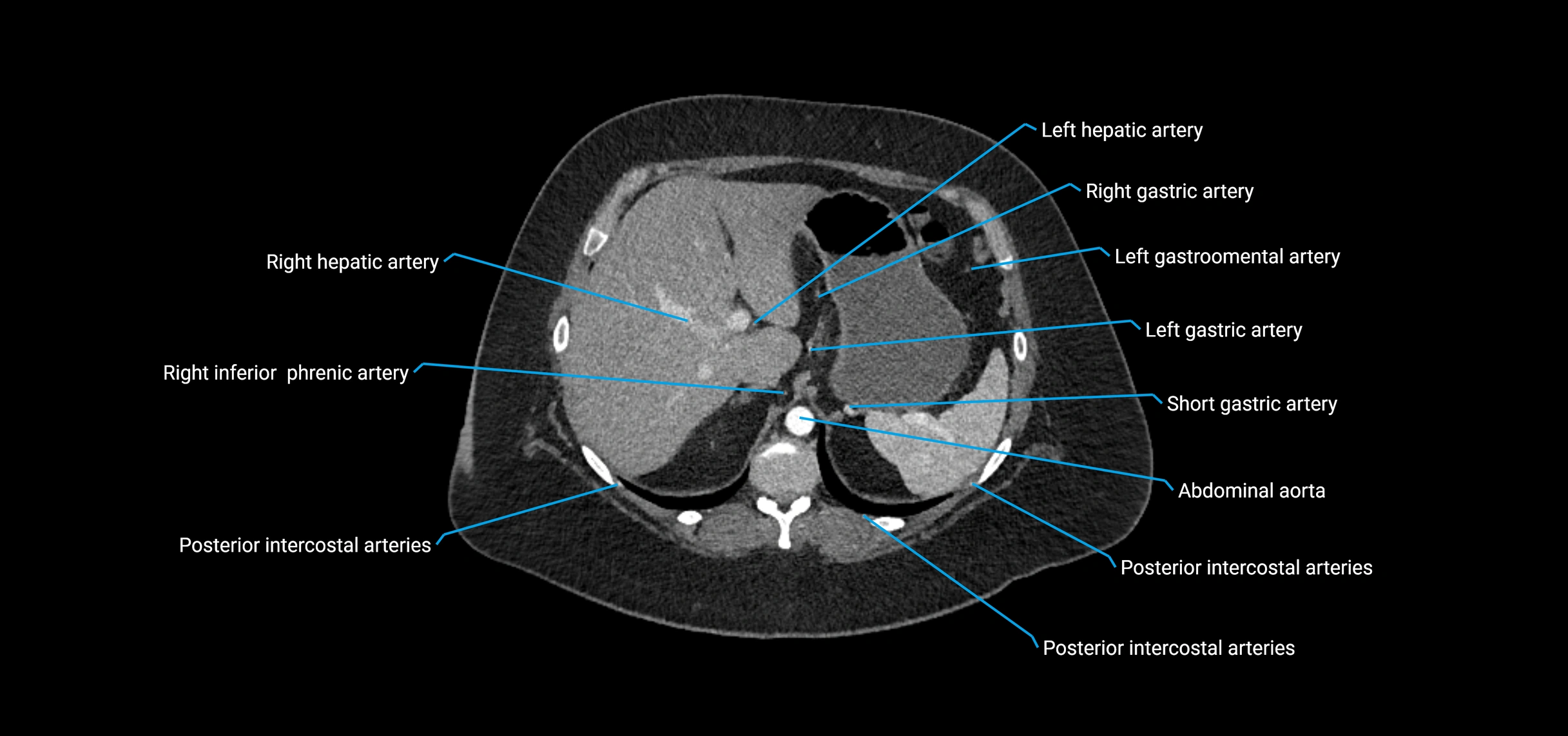 CTA abdomen axial cross sectional anatomy labelled image_39 (2).webp